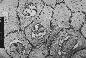 M,66y. | follicular cyst with hyaline Rushton bodies M,66y. | follicular cyst with hyaline Rushton bodies